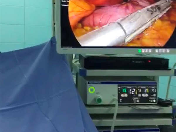 TGS Endo Cutter and Reload Offer Perfect Solution on Bariatric Surgery